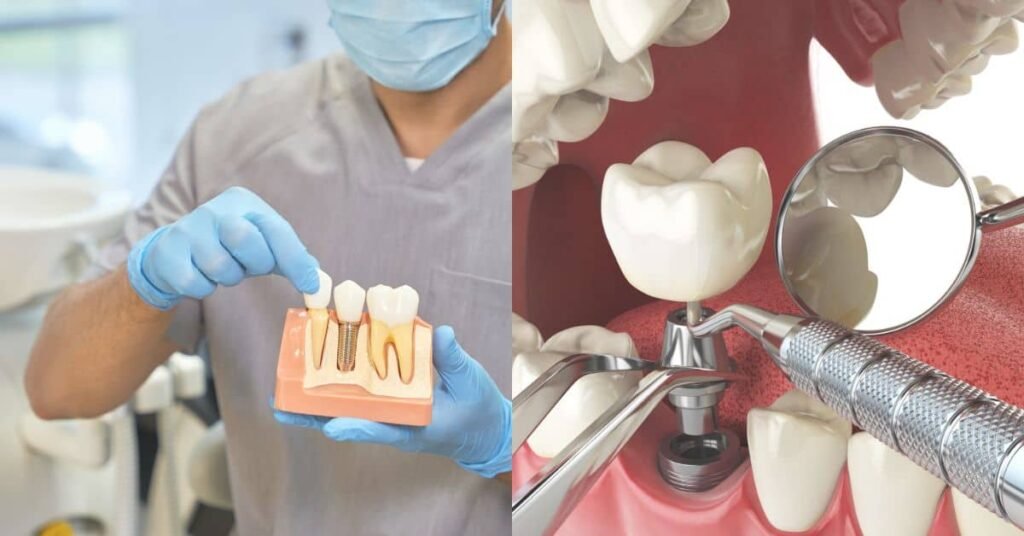 Dental Implant Cost In Malaysia 2023