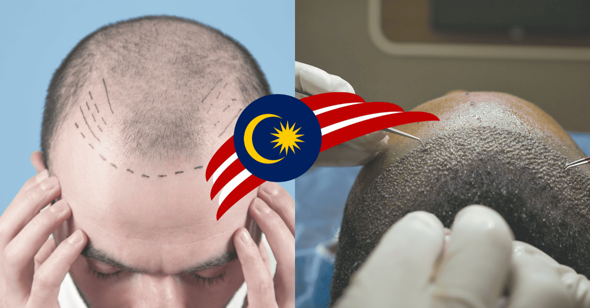Hair Transplant Cost in Malaysia